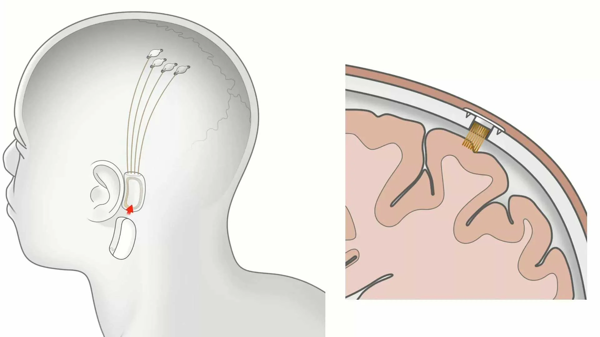 NeuraLink Nedir? Elon Musk'ın Çılgın Projesi neuralink NeuraLink Nedir? Elon Musk'ın Çılgın Projesi neuralink